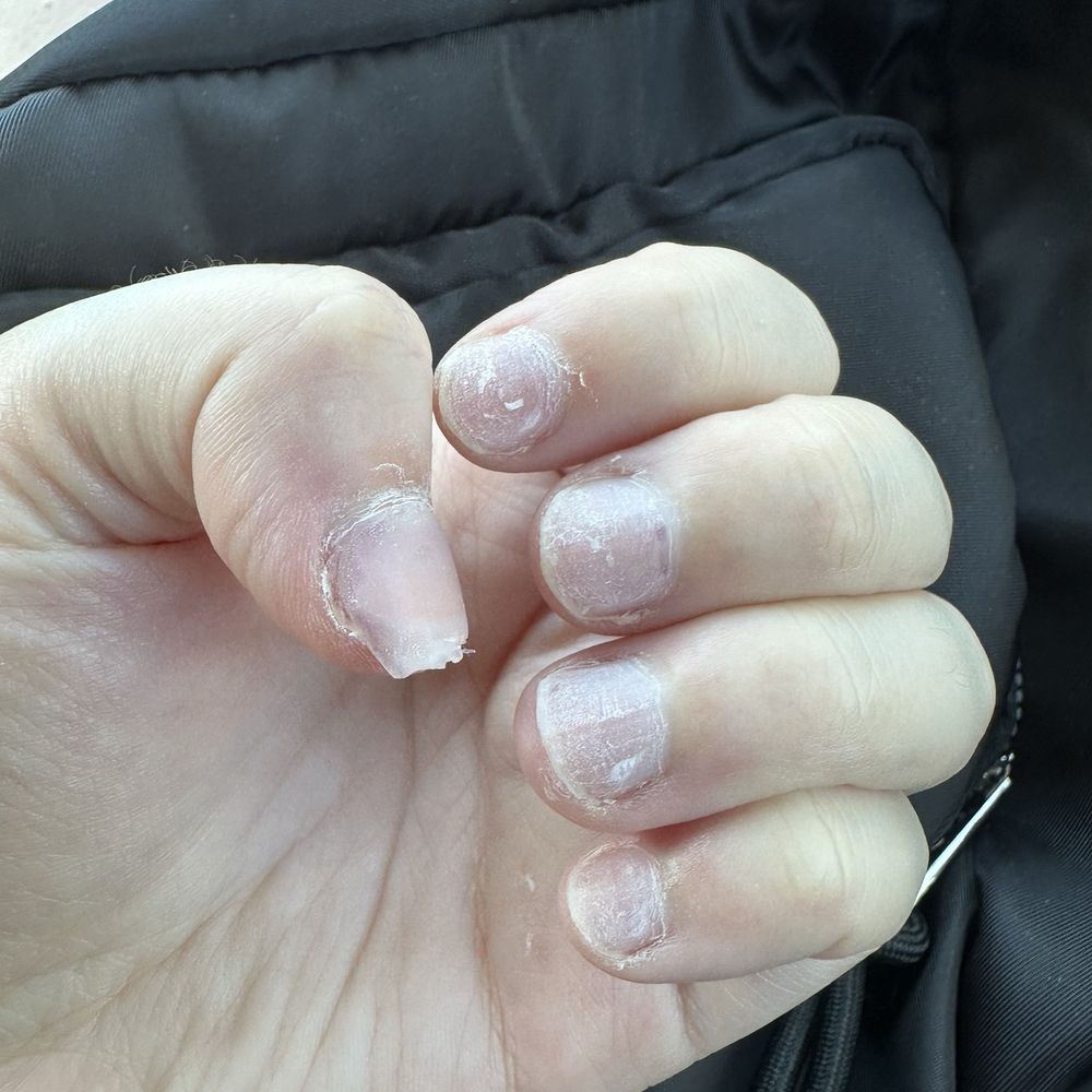 Queen Nails - Left hand, after nail removal appointment - Waxing Near Me - Salem, Oregon Queen Nails - Left hand, after nail removal appointment - Waxing Near Me - Salem, Oregon