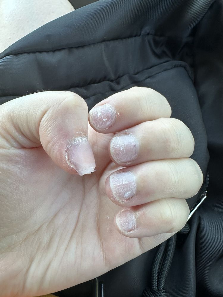 Queen Nails - Left hand, after nail removal appointment - Waxing Near Me - Salem, Oregon Queen Nails - Left hand, after nail removal appointment - Waxing Near Me - Salem, Oregon
