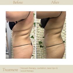 Dolce Beaute - Vacuum therapy, cavitation, laser lipo & wood therapy after 1 session.