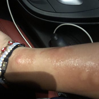 Happy Foot Spa - More spider bites. - Massage Near Me - Downey, California