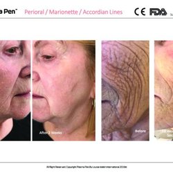 Beautiful Laser Center - Plasma Pen Facelift and Wrinkle Reduction