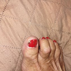 Hollywood Nails - The large scab from the procedure. And it's very painful too to this day. I had it done 5 days ago