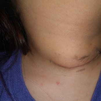 Sina Nasri MD - 5 days after surgery - Ear Nose & Throat Near Me - Las Vegas, Nevada Sina Nasri MD - 5 days after surgery - Ear Nose & Throat Near Me - Las Vegas, Nevada