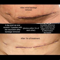 Bellaire Massage Therapy - Dolphin MPS C-Section Scar Session.