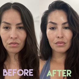 Facial treatment before and after