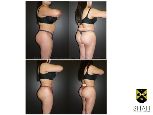 Shah Aesthetic Surgery - Rhinoplasty and Facelift Specialist by null