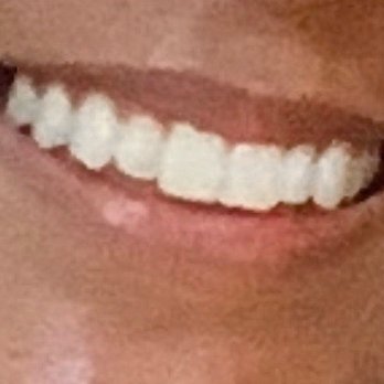 All In One Dental Innovations - Here's a recent picture! I've had my braces off for three years and a few cleanings since then, and my teeth are still straight :) - Cosmetic Dentists Near Me - Dublin, California All In One Dental Innovations - Here's a recent picture! I've had my braces off for three years and a few cleanings since then, and my teeth are still straight :) - Cosmetic Dentists Near Me - Dublin, California
