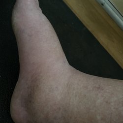 Del Paso Heights Community Health Center - My brothers swollen feet