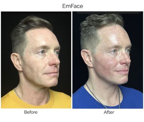 Emface - Emface uses synchronized radiofrequency and HIFEs to stimulate muscle tone and collagen in the skin. We can treat forehead. Under eyes, cheeks and under chin. In addition we can treat massette muscles to relax them. Emface - Emface uses synchronized radiofrequency and HIFEs to stimulate muscle tone and collagen in the skin. We can treat forehead. Under eyes, cheeks and under chin. In addition we can treat massette muscles to relax them.
