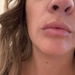 Shawn B Davis, DMD - Oral and Facial Surgery Institute - The scar after it's been healed for 3 weeks that I have to live with now.