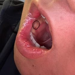 Sunshine Dental Center LLC - A couple days after my 1st appointment, my lip got infected and my healthy tooth ruined by her!