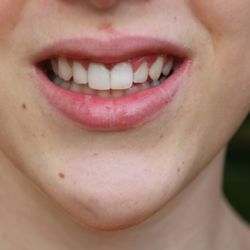 Santa Monica Bay Dental - Totally restored smile less than 24 hours after the accident.
