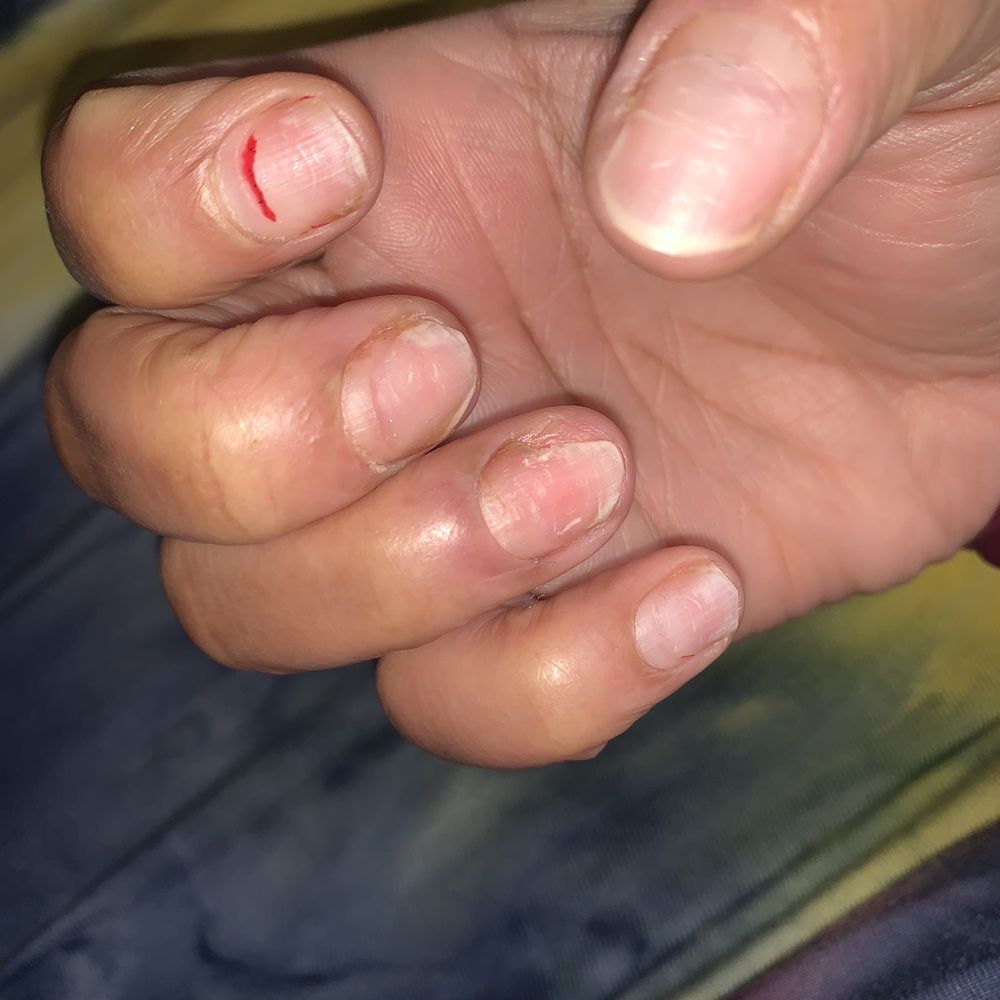 Mindy's Nails & Spa - Two days after nail removal and using OTC nail fungus treatment. - Tanning Near Me - Conyers, Georgia Mindy's Nails & Spa - Two days after nail removal and using OTC nail fungus treatment. - Tanning Near Me - Conyers, Georgia