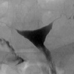 Randy S Morris, MD, SC - IVF1 - HSG or hysterosalpingogram showing a normal uterus and fallopian tubes.
