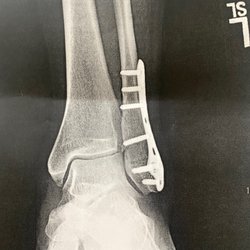 Kansas City Bone & Joint Clinic - Malleolus repair by Dr. Bleazard
