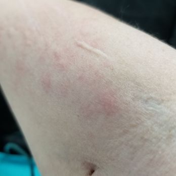 Wendy's - Hives from wendys! - Burgers Near Me - Auburn, Washington