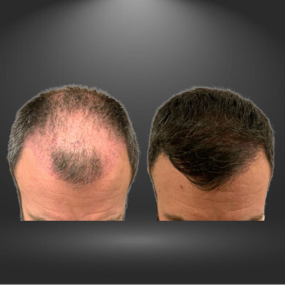 Hair Transplant Quincy Massachusetts
