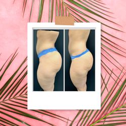 Body By Blu - Lipo Kevin Tatian, radio frequency and Brazilian butt lift