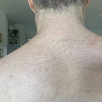 LaserAway - Never had this much hair on my back. - Laser Hair Removal Near Me - San Diego, California LaserAway - Never had this much hair on my back. - Laser Hair Removal Near Me - San Diego, California