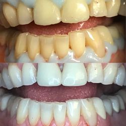 Mile High Hygiene Spa - Subtle, painless teeth whitening