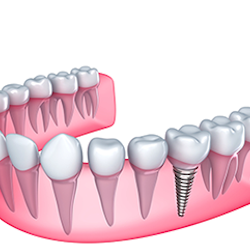 Lantern Dental - Lantern Dental | Desoto, TX