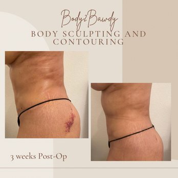 Body2Bawdy - Post Op Massage Results - Body Contouring Near Me