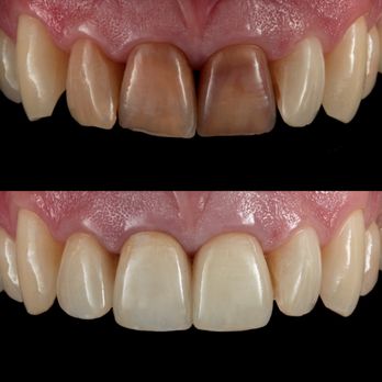 Brookline Dental Esthetics - Fixing Discolored teeth with Ceramic Crowns - General Dentistry Near Me - Brookline, Massachusetts Brookline Dental Esthetics - Fixing Discolored teeth with Ceramic Crowns - General Dentistry Near Me - Brookline, Massachusetts