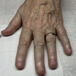 Pewter - Eight months ago.  Brittle split nails.