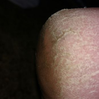 Modern Nails - My heel AFTER the pedicure! - Nail Salons Near Me - Pittsburgh, Pennsylvania