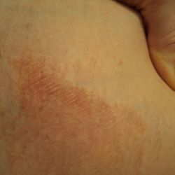 New Look Salon - Burn mark