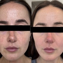 Skinlab South Bay - Before and after from the Revepeel enlighten
