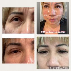 The Skin Agency - Under eye prp