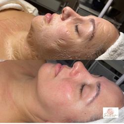 Seven Layer Skin - Super protein firming mask during and after.