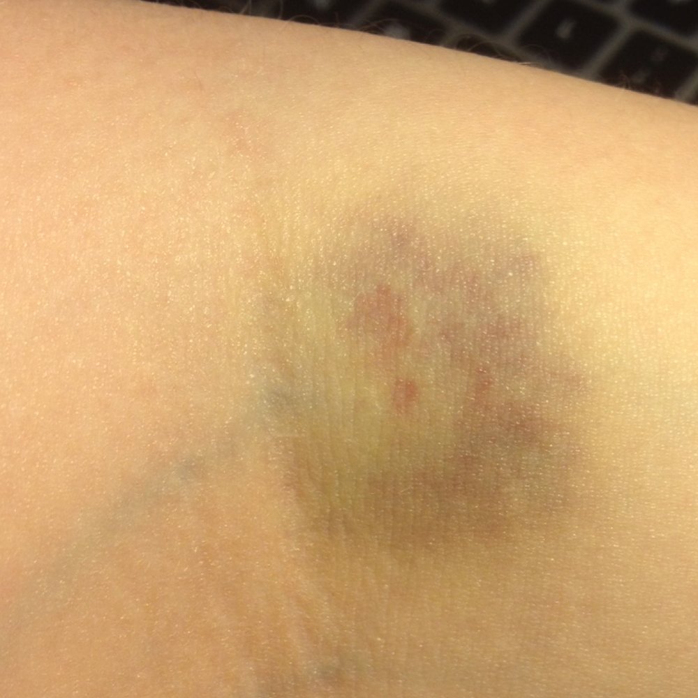 Quest Diagnostics - Thats how are blood samples are being taken here. Bruises stays for 2 weeks. - Laboratory Testing Near Me - San Carlos, California Quest Diagnostics - Thats how are blood samples are being taken here. Bruises stays for 2 weeks. - Laboratory Testing Near Me - San Carlos, California