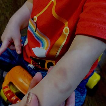 Little Sunshine's Playhouse - This is one of so many other bite marked my son came home with . - Preschools Near Me - Austin, Texas Little Sunshine's Playhouse - This is one of so many other bite marked my son came home with . - Preschools Near Me - Austin, Texas