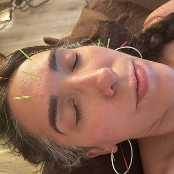 Pulse Acupuncture - acupuncture session - Acupuncture Near Me - Clifton, New Jersey Pulse Acupuncture - acupuncture session - Acupuncture Near Me - Clifton, New Jersey