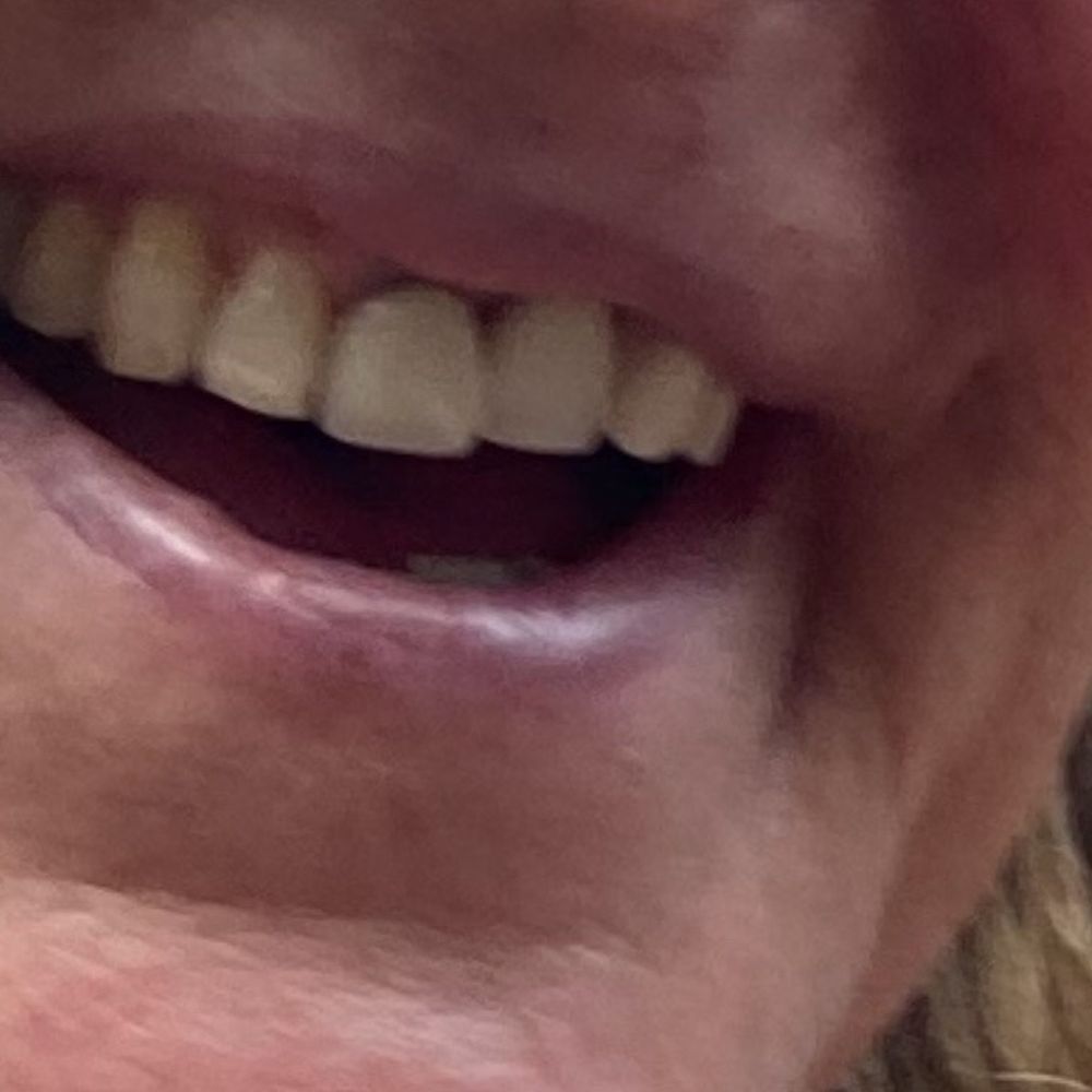 Brooklyn Dental Studio - Before - Prosthodontists Near Me - Brooklyn, New York