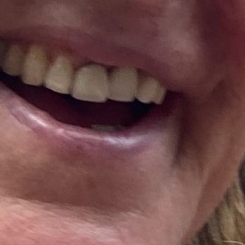 Brooklyn Dental Studio - Before - Prosthodontists Near Me - Brooklyn, New York Brooklyn Dental Studio - Before - Prosthodontists Near Me - Brooklyn, New York