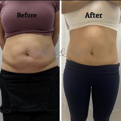 Aries Beauty & Wellness - Body sculpting package of 6 includes RF, body sculpting and cavitation.
