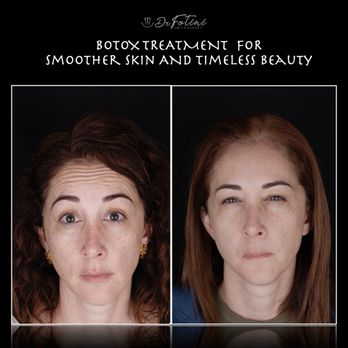 Fotini Chrisopoulos DDS, MS - Botox is used not only for TMJ and muscle pain but also to restore facial aesthetics and reduce wrinkles providing a youthful look! - General Dentistry Near Me - Tysons, Virginia Fotini Chrisopoulos DDS, MS - Botox is used not only for TMJ and muscle pain but also to restore facial aesthetics and reduce wrinkles providing a youthful look! - General Dentistry Near Me - Tysons, Virginia