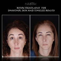 Fotini Chrisopoulos DDS, MS - Botox is used not only for TMJ and muscle pain but also to restore facial aesthetics and reduce wrinkles providing a youthful look!