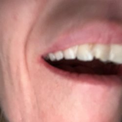 Elica Health Centers - Franklin - My chipped tooth received a lot of trama on the 23rd and I just could not bare the pain anymore!