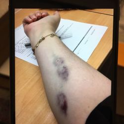 Emergency Department at UPMC Magee-Womens Hospital - Bruised arm.