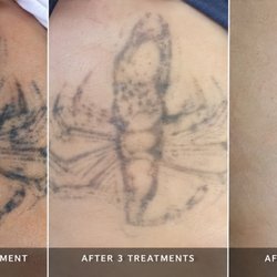 MEDermis Tattoo Removal - Scorpion tattoo removal in just 6 treatments! See the incredible results. 20+ years of experience in Austin & San Antonio. #MEDermis