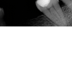 Mass Dental Associates - Owner implanted something in my tooth and I am terrified.