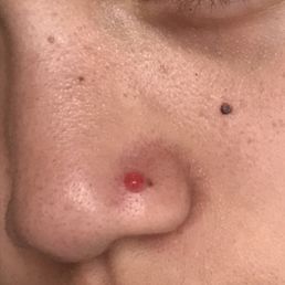 bump which formed from my improperly angled nose piercing ): had to remove the stud