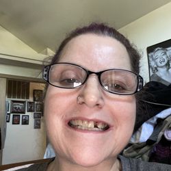 Walker Family Dental - Broken tooth after losing a filling and not getting it taken care of before the tooth broke (been dealing with my husband's death).