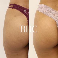 Basma Hameed Clinic - Lipo Scar