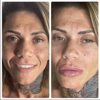 Sn Beauty Med Spa - Juvederm lip fillers before and after - Medical Spas Near Me - Irving, Texas