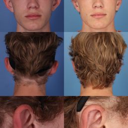OTOPLASTY